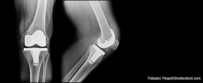 xray of knee